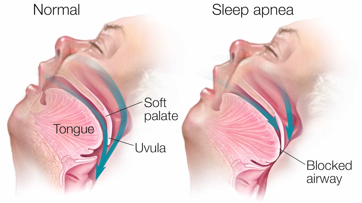 sleep apnea diagram