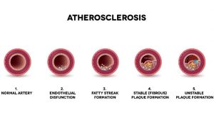 atherosclerosis types