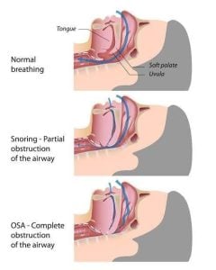 Normal breathing versus airway obstruction in OSA
